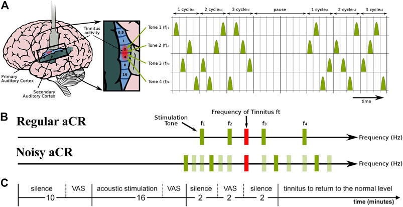 Treatment Tone Spacing and Acute Effects of Acoustic Coordinated Reset Stimulation in Tinnitus Patients